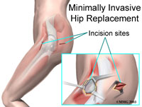 Types Hip Replacement