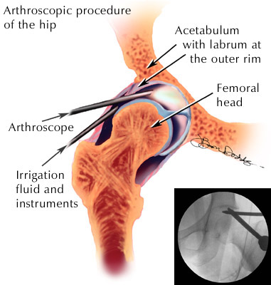 Types Hip Replacement