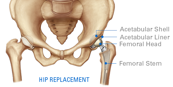 Hip Replacement