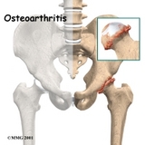 Types Hip Replacement